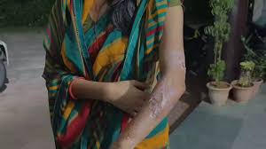 हैवानियत की सारी हदे पार :सास-ससुर और पति ने महिला को एक सप्ताह तक बंधक बनाकर गर्म सलाखों से दागा