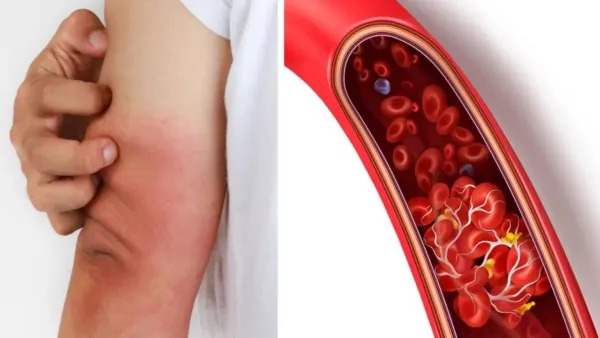 अलर्ट! रक्त थक्के के ये लक्षण हो सकते हैं खतरनाक, तुरंत दिखाएं डॉक्टर को