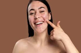 पाना चाहते हैं चेहरे के दाग-धब्बों से छुटकारा, तो ट्राई करें ये घरेलू उपाय 