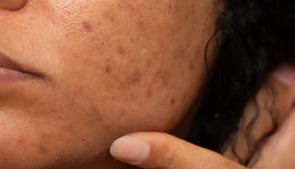 बेदाग और निखरी त्वचा के लिए मुलेठी से ऐसे बनाएं फेस पैक