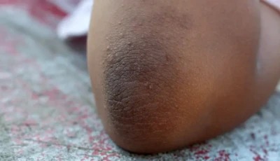  घर बैठे हटाएं कोहनियों का कालापन, अपनाएं ये आसान नुस्खे
