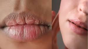 Lips Care:इन आसान घरेलू नुस्खों से पाएं फटे होंठ से निजात 