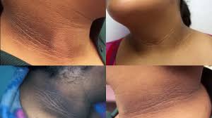 काली गर्दन अब नहीं बनेगी शर्मिंदगी की वजह,जानें बचाव के टिप्स