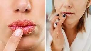 फटे होंठों के लिए विशेष उपाय,घर पर ही बनाएं ये जेल 