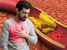 हाई कोलेस्ट्रॉल बनाम हाई ब्लड प्रेशर: दिल के लिए कौन ज्यादा खतरनाक? जानिए एक्सपर्ट राय