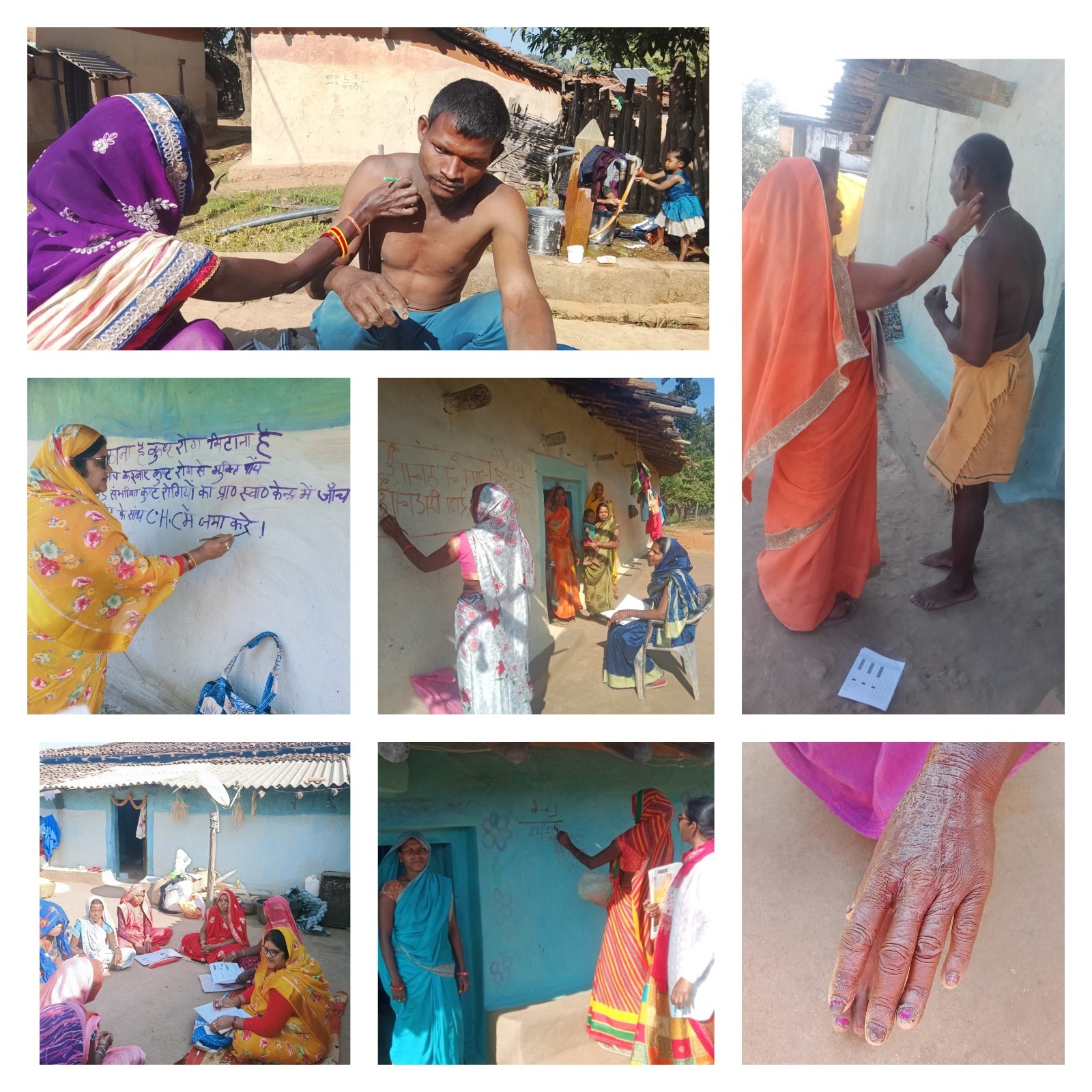 सघन कुष्ठ खोज अभियान - घर-घर पहुंच रही स्वास्थ्य विभाग की टीम